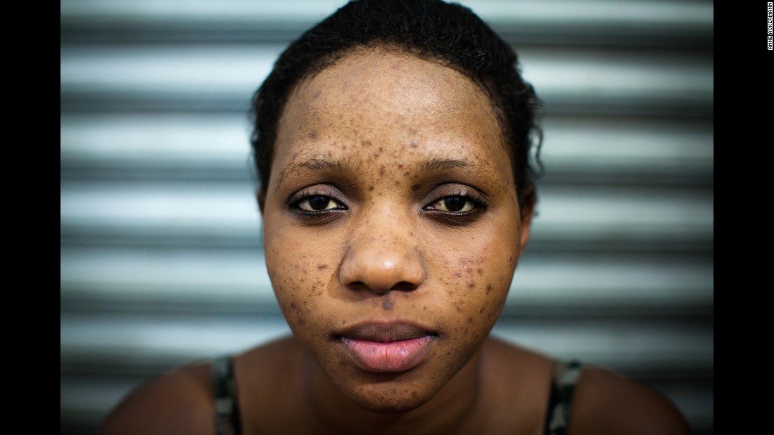 The Risks and Rewards of Skin Bleaching